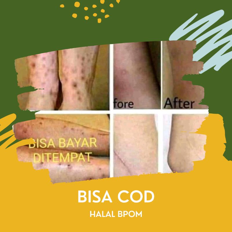 PENGHILANG BEKAS LUKA DAN KORENG VITALINE