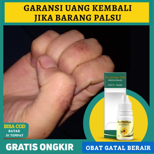 Maeilla Kharisma Twitter પર Gatal Bintik Berair Di Sela Jari Tangan Apa Obatnya Https T Co X3lzppdah1 Https T Co Dtxf0ulvbv Twitter