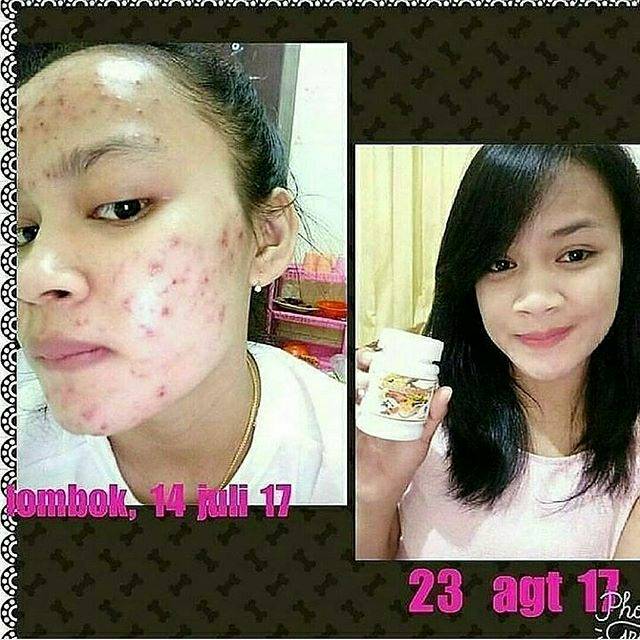 Frutablend Obat Jerawat Paling Ampuh Original Hwi Shopee Indonesia