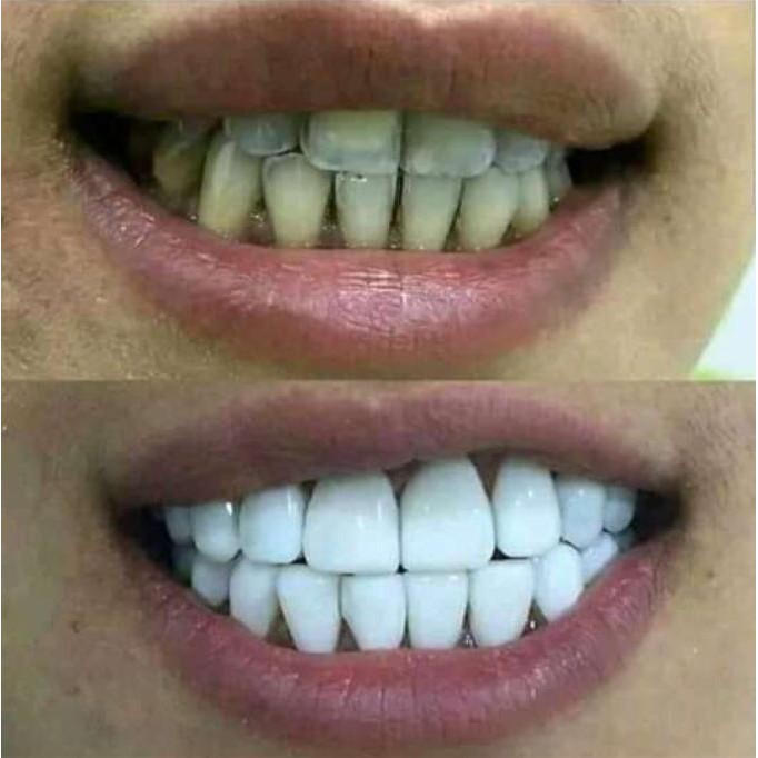 Tooth Decay | PENUMBUH GIGI BERLUBANG | SAKIT GIGI | SAKIT GUSI | SARIAWAN | FLAK DAN KARANG GIGI | 