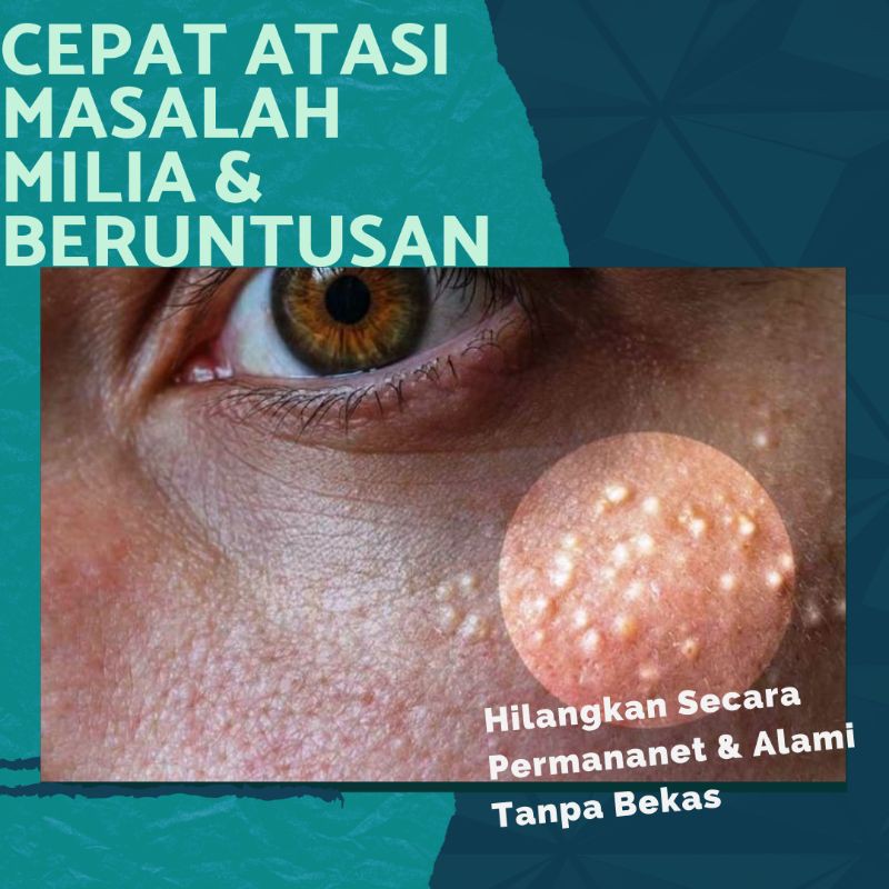 CARA AMPUH BASMIHILANGKAN MILIA,BERUNTUSAN,SECARA ALAMI & PERMANENT