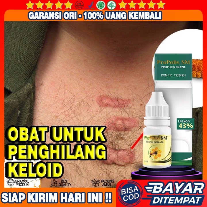 Jual Obat Keloid, Obat Perontok Keloid, Obat Penghilang Keloid, Obat