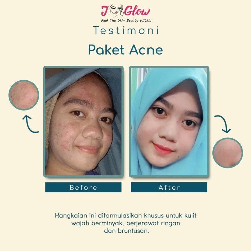 jglow skincare paket acne / j-glow skincare paket acne / j glow skincare paket acne / cream jglow