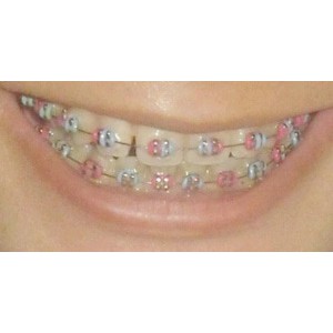  Behel  Lepas Pasang Asli  Atas Bawah Double Power O 