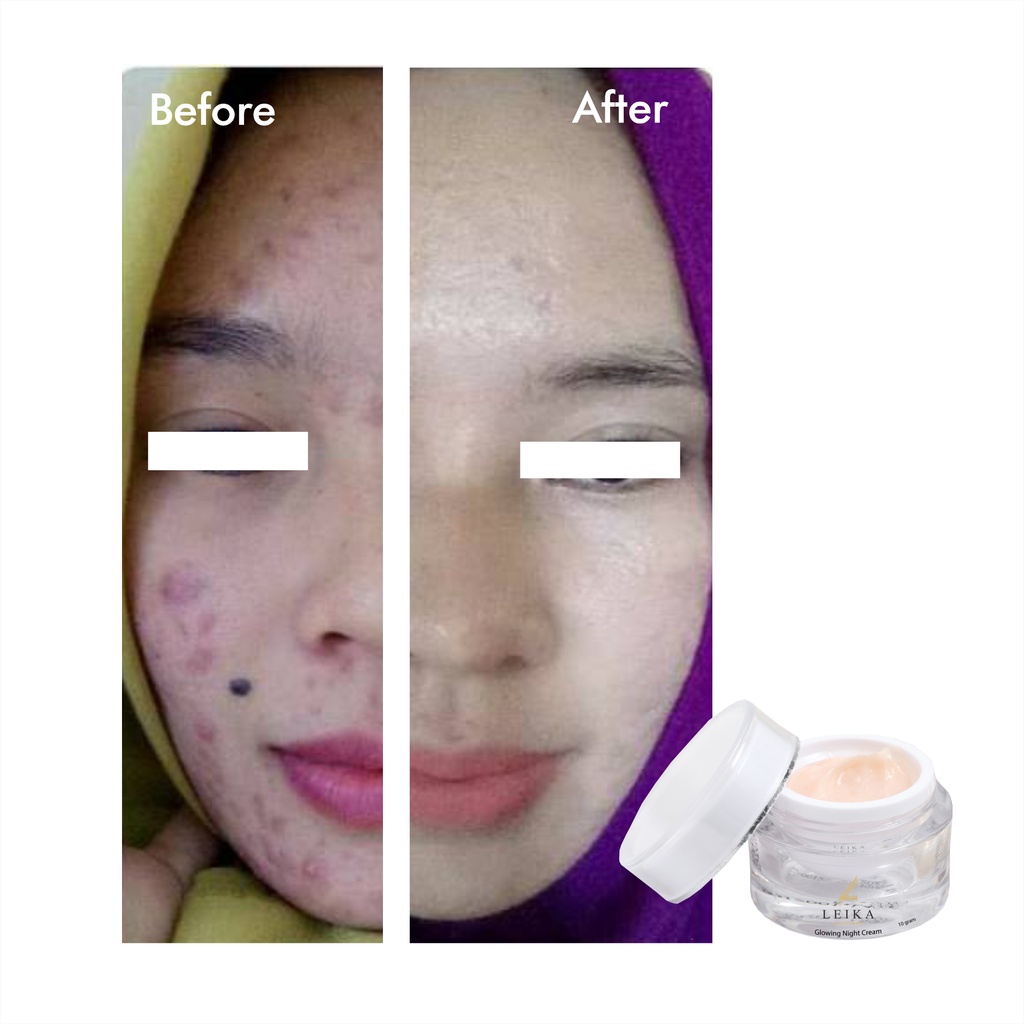 Cream Penghilang Jerawat Penghilang Bekas Jerawat Ampuh! Obat Jerawat dan Bekas Jerawat Obat Jerawat Paling Ampuh untuk Wanita Penghilang Jerawat dan Bekas Jerawat Glowing Night Cream Leika Skincare Resmi BPOM cream wajah berminyak dan berjerawat