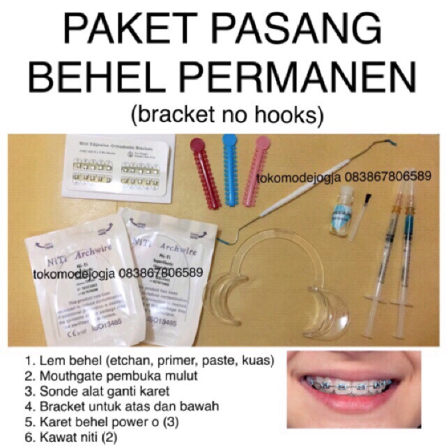 Paket Pasang Behel Nohook Permanen Metal Lengkap dengan Lem Behel Mouthgate Kawat Karet