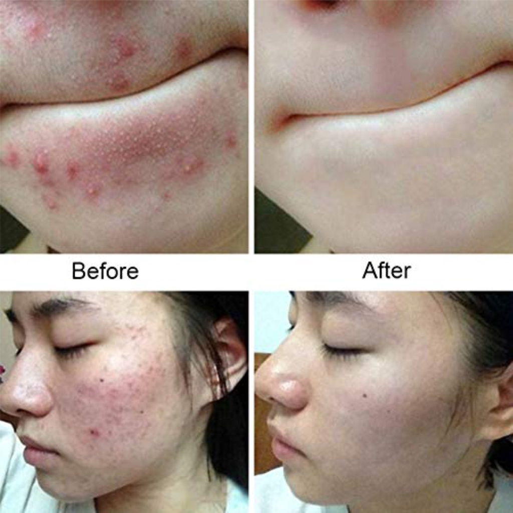SHINE STAR - ORIGINAL 100% BPOM Sabun QM Anti Acne -Sabun Ampuh Menghilangkan Jerawat dan Bekas Jerawat /Flek