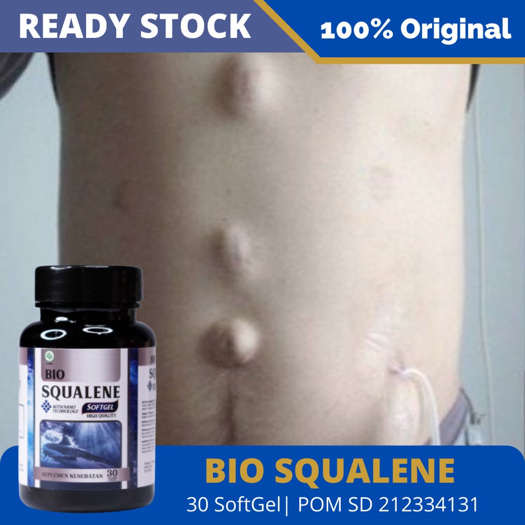 Obat Hernia Turun Berok Herbal, Obat Hernia Anak Dan Dewasa, Obat Turun Berok, Obat Hernia Alami, Obat Hernia Untuk Bayi, Obat Herbal Usus Turun, Obat Usus Turun Anak – Bio Squalene Herbal Alami Original