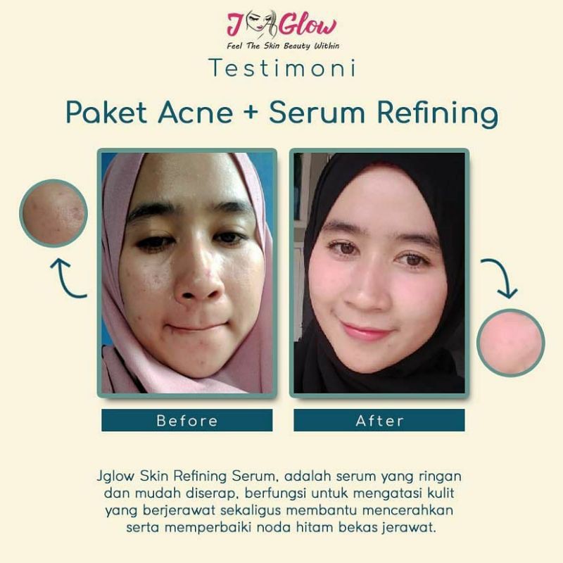Jglow Skincare Paket Acne Whitening Cream Skin glowing Perawatan Wajah Berjerawat Beruntusan Bpom-7