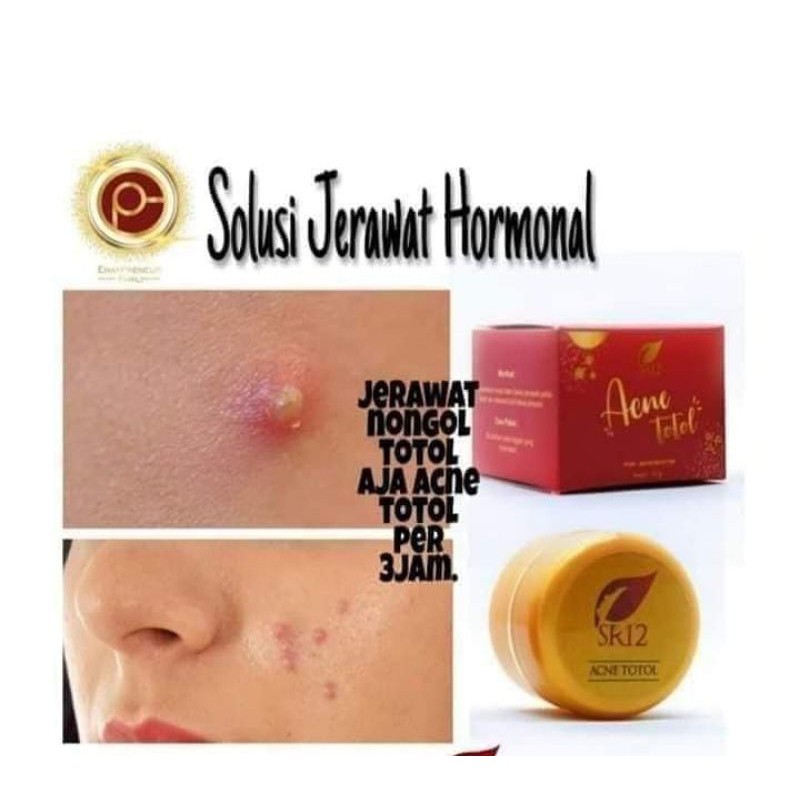 Acne Totol SR12 Krim Jerawat Hormonal - Cream Jerawat Satuan Ampuh BPOM