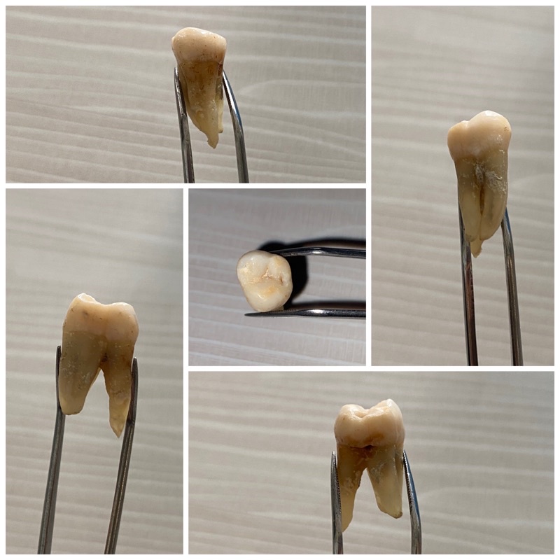 gigi molar atas