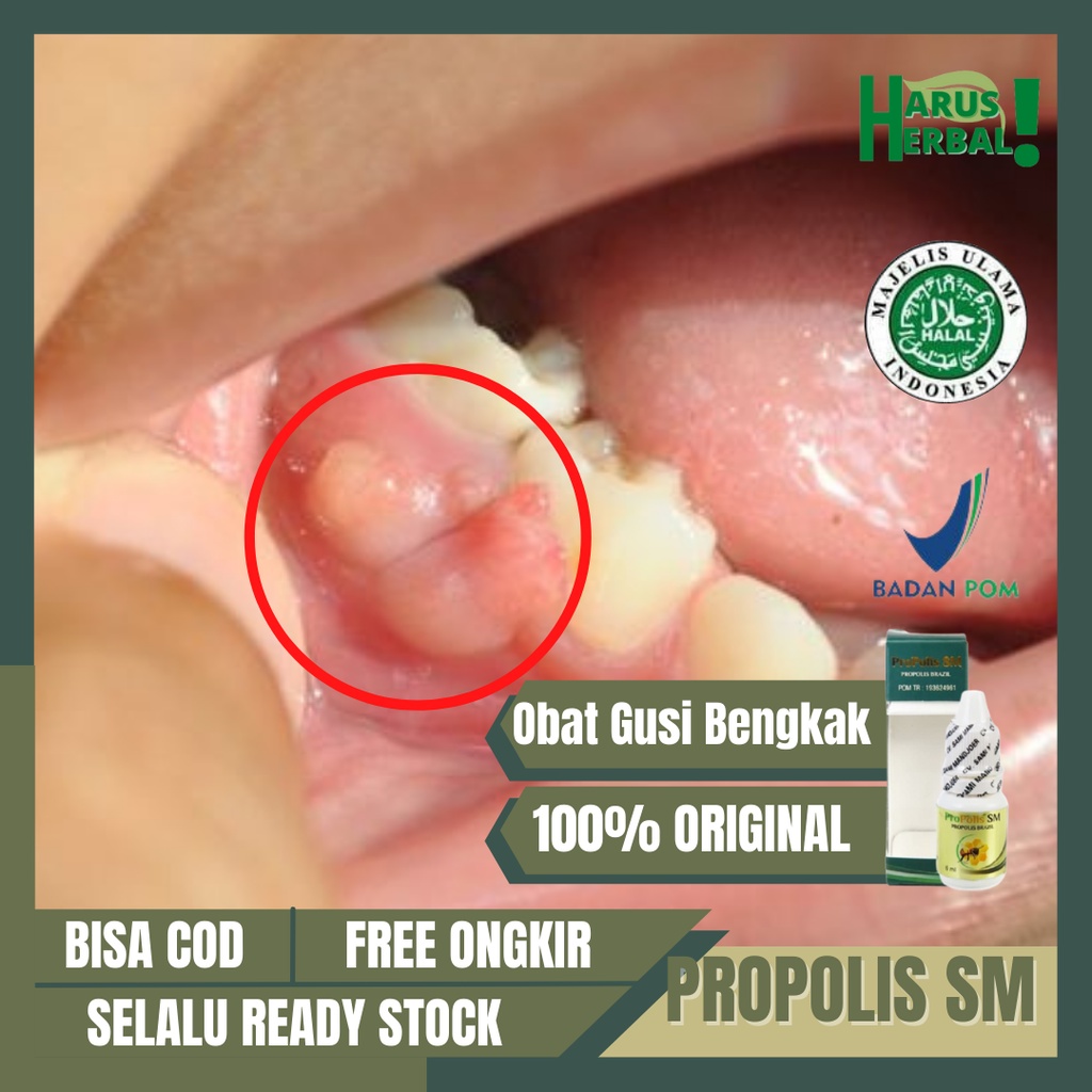 Obat Gusi Bengkak, Obat Radang Gusi, Obat Gusi Berdarah Bernanah, Obat Nyeri Gusi, Obat Gusi Ngilu, 