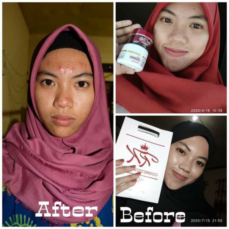 Rk glow premium/Rk glow acne