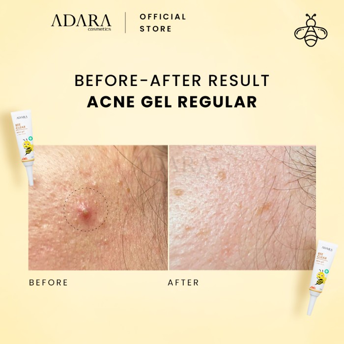 ADARA - Bee Clear Acne Gel Original BPOM