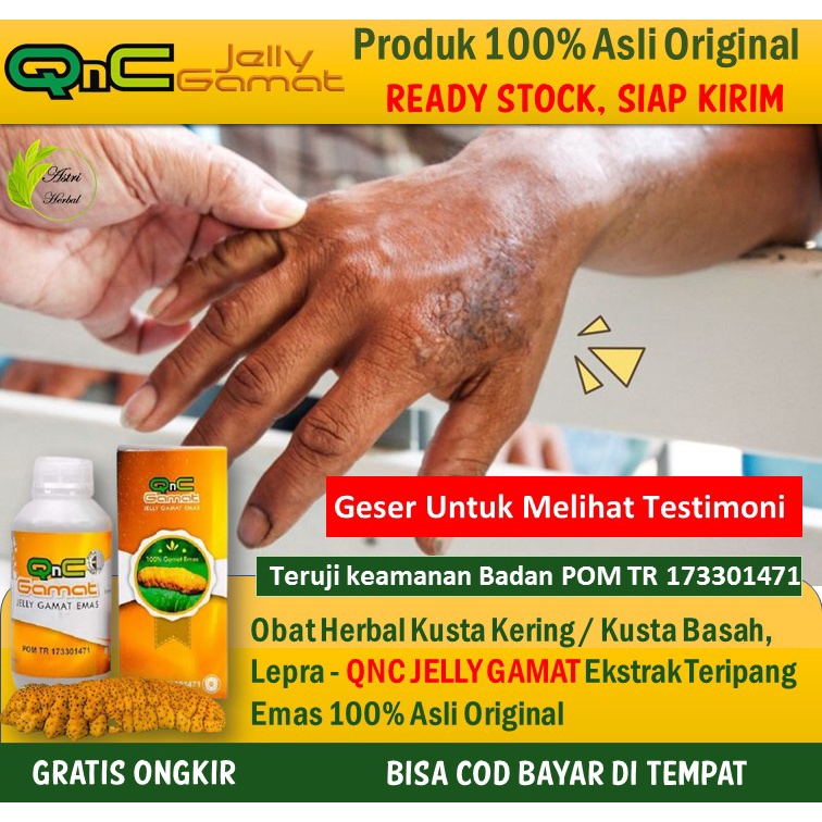 Jual Obat Lepra, Obat Kusta, Kusta Kering/Basah, Luka Pada Kulit - QNC ...