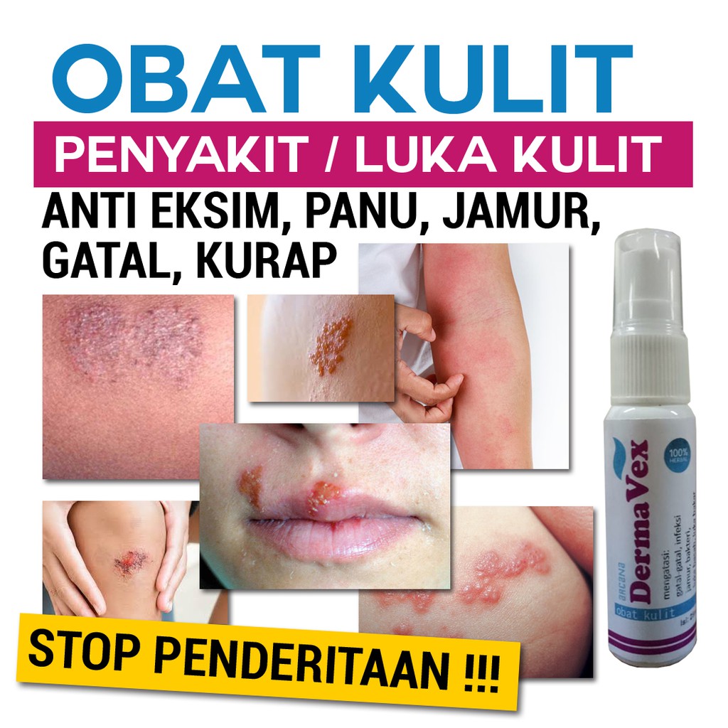 OBAT KULIT TERBAIK, ALERGI, JAMUR, GATAL GATEL LEHER, PANU, EKSIM, DLL-5