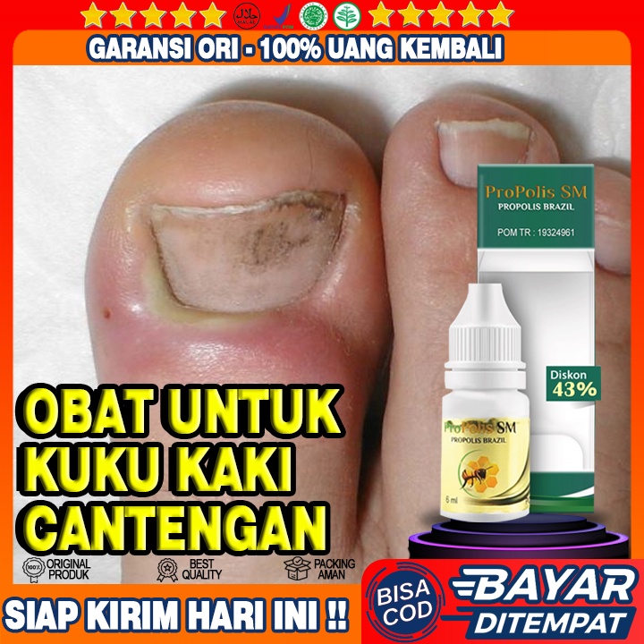 Obat Cantengan, Obat Cantengan Jempol Kaki, Obat Cantengan, Obat Jamur Kuku, Obat Cantengan Kuku Kak