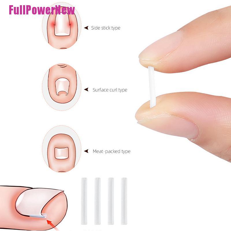 [Full] 10pcs Toenail Straightening Clip Ingrown Toenail Correction Nail Patch Sticker