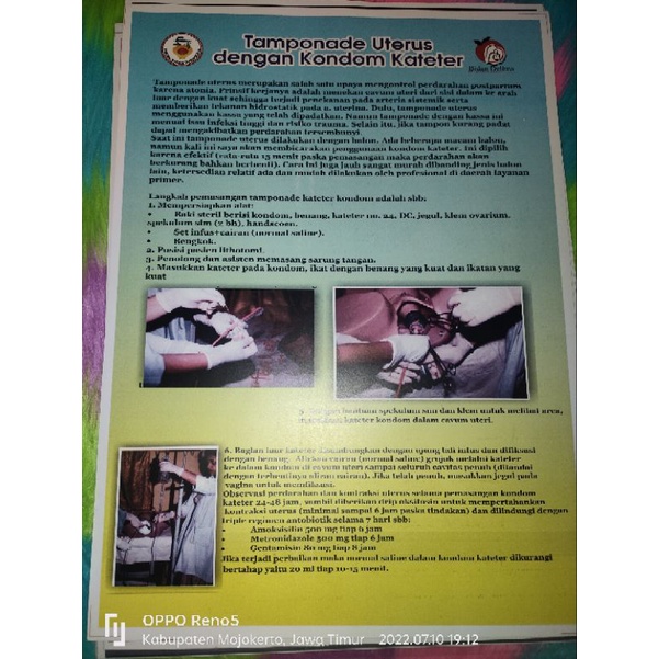 

Poster Tamponande Uterus dengan Kondom Kateter
