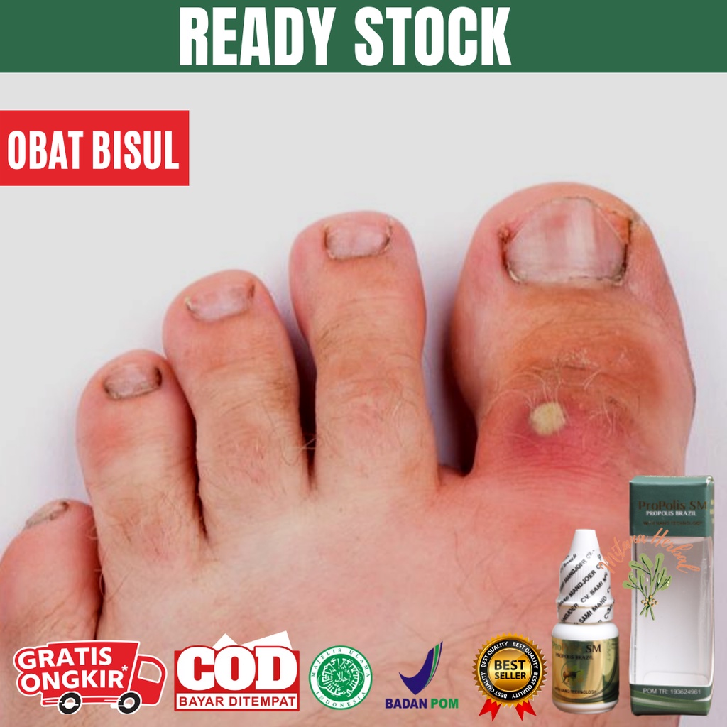 Obat Bisul Di Kaki, Bisul Di Pantat, Bisul Di Ketiak, Bisul Di Kelamin, Bisul Bernanah - Propolis Sm