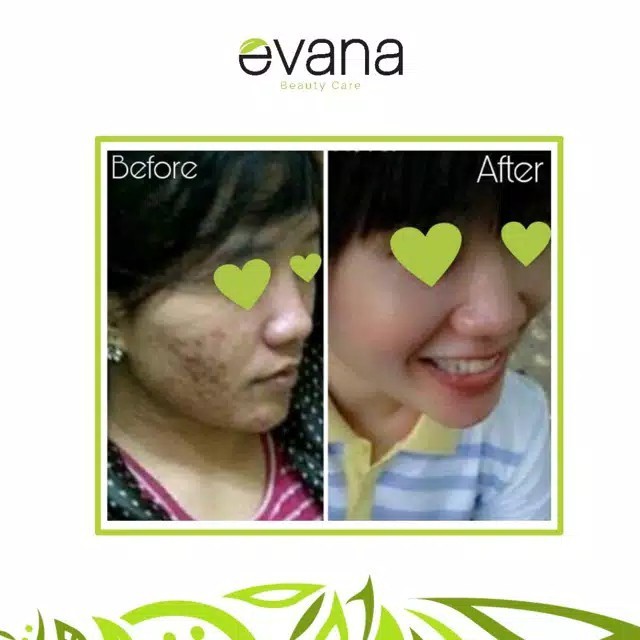 EVANA BEAUTY CARE - PAKET JERAWAT - JERAWAT- JERAWAT HILANG BPOM