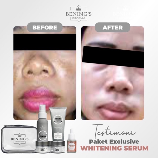 BENING'S PAKET EXCLUSIVE | MENGATASI MASALAH FLEK, MELASMA &amp; MENCERAHKAN