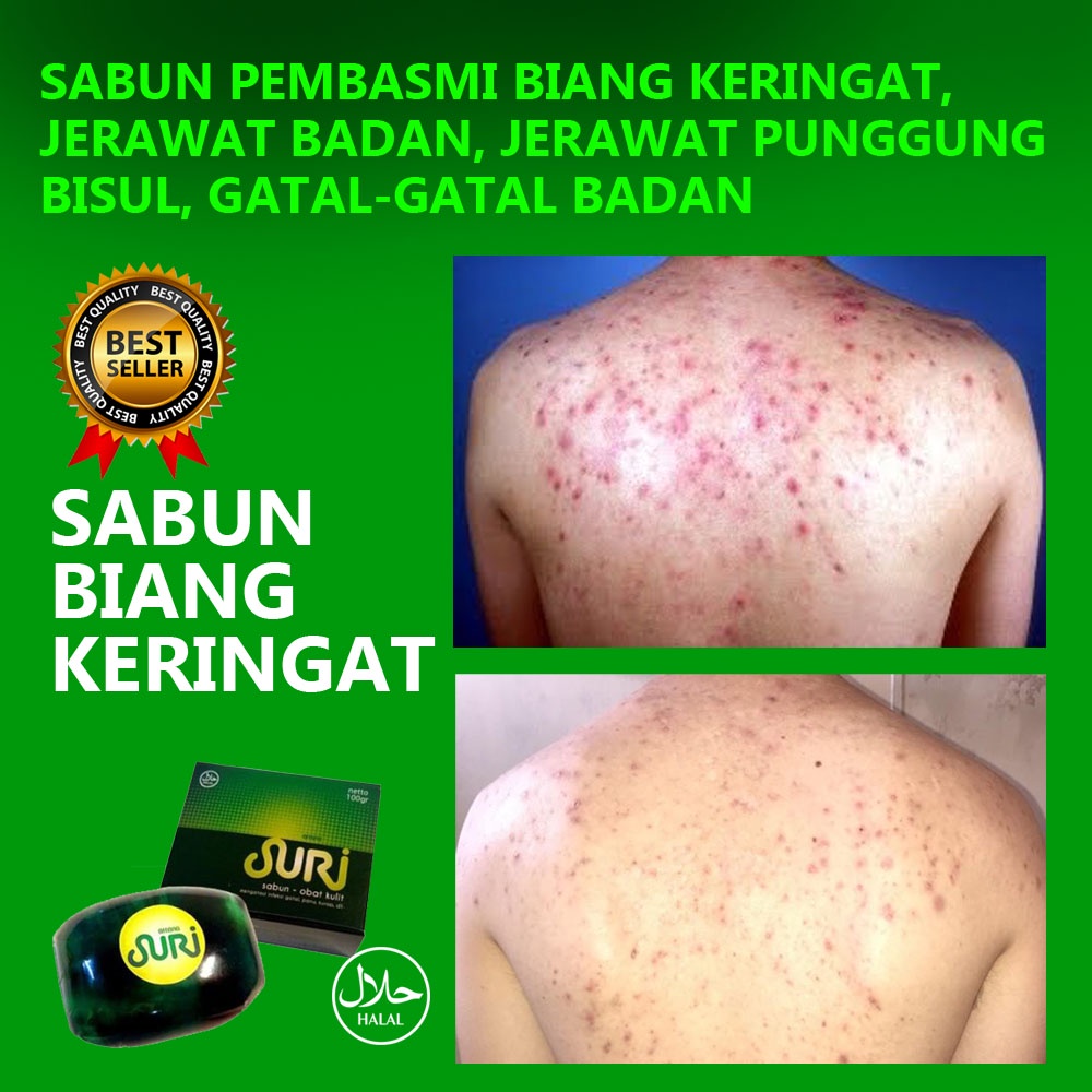 Sabun Penghilang Jerawat Badan Biang Keringat Punggung - Sabun Suri