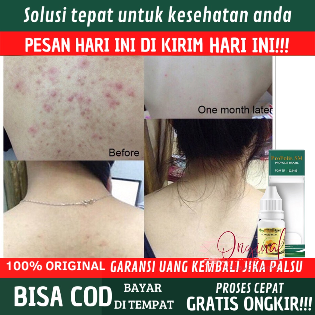 Obat Jerawat di punggung, Obat Jerawat punggung, Salep Jerawat punggung, Obat jerawat badan, Obat Je