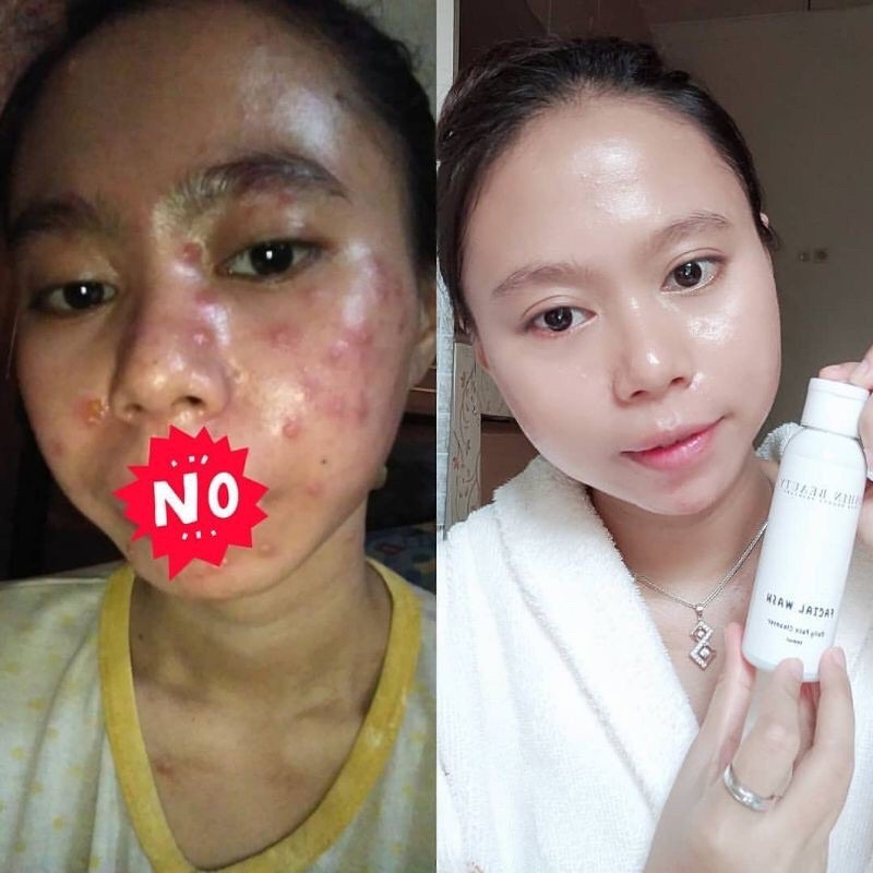 (OSHINBEAUTY) Paket Skincare Glow dan Acne Series Complete BPOM [Free Gift/Bonus]-7