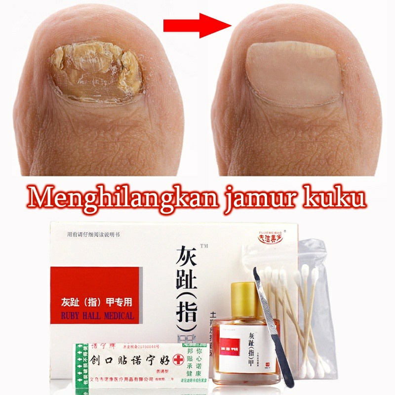 Perawatan kuku Obat jamur kuku 25ml kuku menebal / Atrofi kuku / lapisan kuku / kuku rontok / perubahan warna kuku / kuku bergelombang