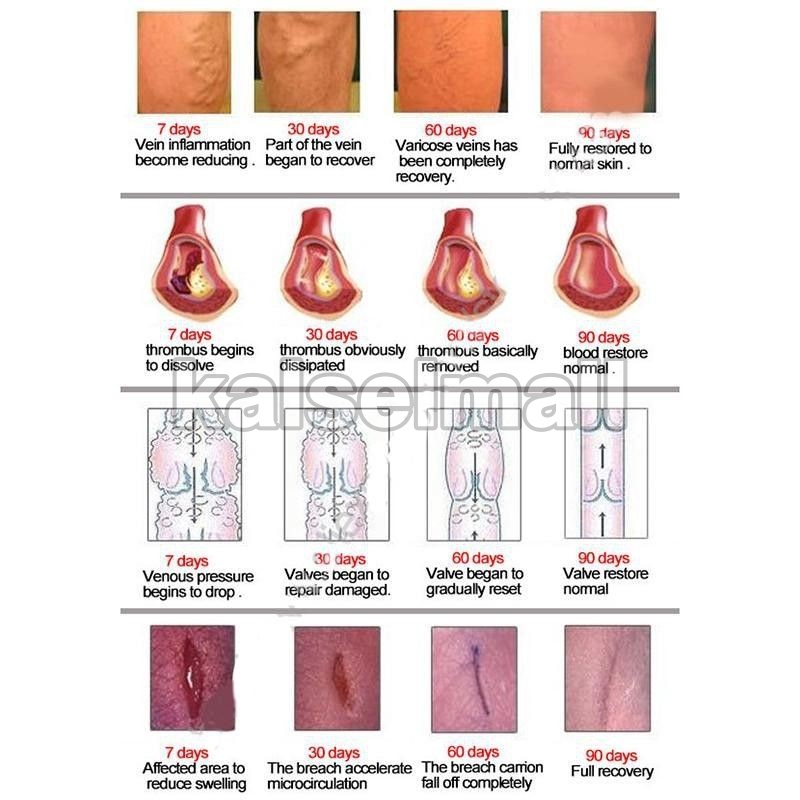 Obat Salep Krim Cream Penghilang Varises Paises Herbal Aman 100% ORIGINAL Maiguankanggao Salap Cina Herbal Tanpa Efek Samping Varicose Veins  Parises Ampuh China Untuk Pengobatan Varises Kaki Tangan Badan Kulit Pegal - Pegal OC4