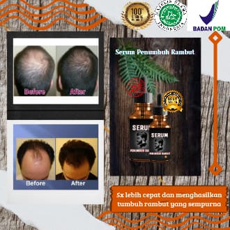 serum penumbuh rambut/serum penumbuh botak pria/serum penumbuh rambut terpercaya/serum penumbuh ramb
