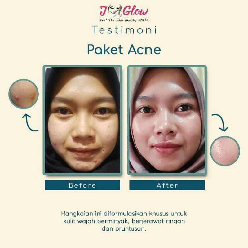 Jglow Skincare Paket Acne Whitening Cream Skin glowing Perawatan Wajah Berjerawat Beruntusan Bpom-6