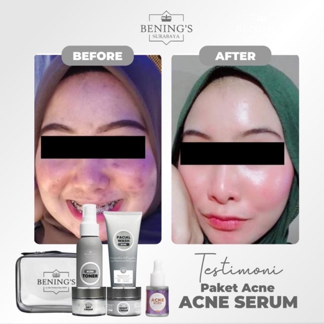 BENING'S PAKET ACNE | MENGATASI MASALAH JERAWAT, BRUNTUSAN &amp; MENCERAHKAN