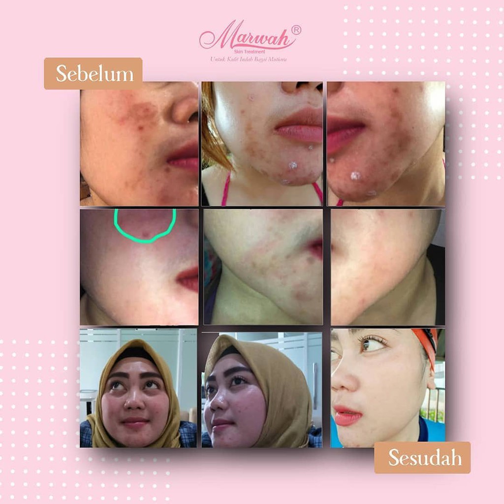 Cream Marwah Marwah Diamond Bright Teatree Diamond Bright Tea Tree Skincare Kulit Berminyak Shopee Indonesia