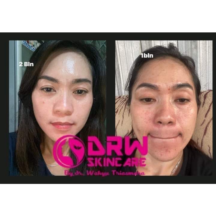 PAKET JERAWAT (ACNE) DRW SKINCARE ORI