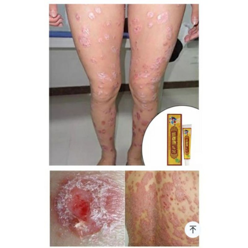 Obat Luar Radang Kulit Herbal Cina Formula Bacteriostati Psoriasis