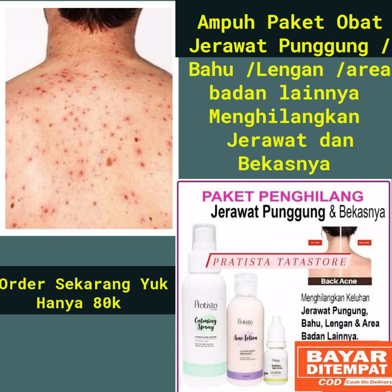 Paket Obat Jerawat Di Punggung Dada Dan Badan Penghilang Jerawat Punggung Obat Jerawat Punggung Shopee Indonesia