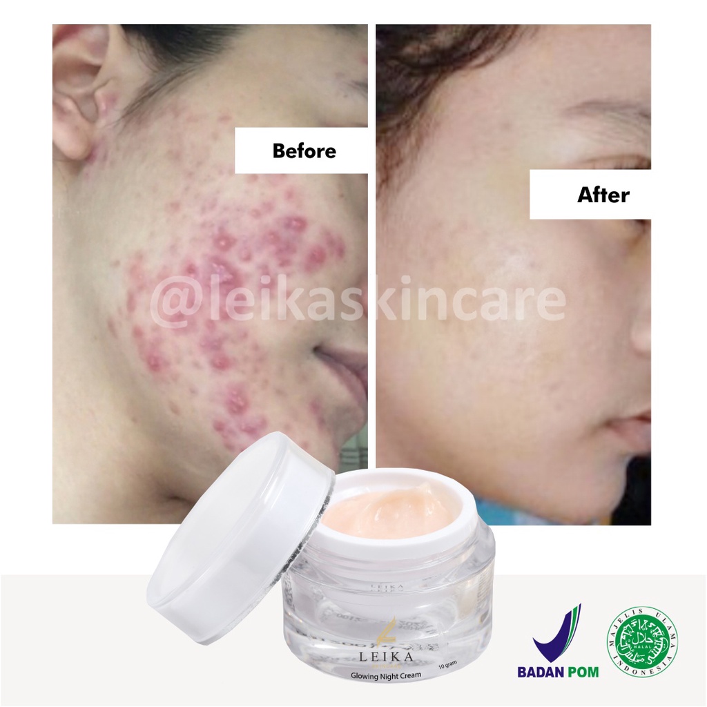 Asli! Penghilang Jerawat dan Bekas Jerawat Pria Wanita Paling Ampuh Permanen Penghilang Jerawat / Jerawat Pasir / Jerawat Batu / Bruntusan  - Leika Skincare Glowing Night Cream 100% Resmi BPOM Halal