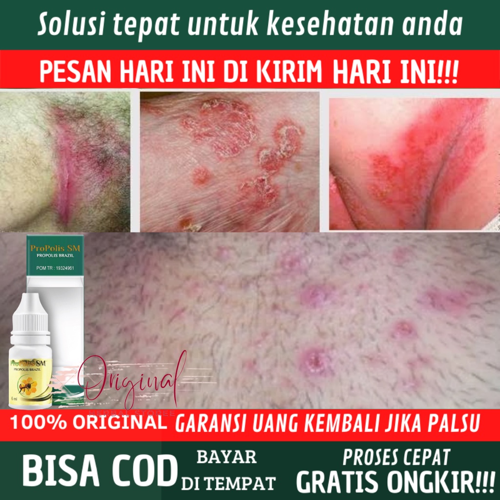 Obat gatal Kelamin Pria & Wanita, Obat Gatel Selangkangan, Obat Gatal Selangkangan, Salep gatel Sela