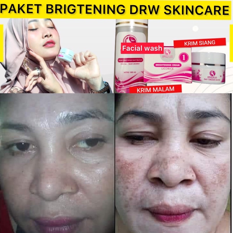 Drw Skincare Paket Flek  Cream Jerawat Kecantikan Perawatan wajah Cream Flek Hitam Membandel Serum  