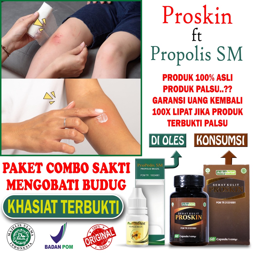 Obat Budug Bernanah Santri Buduk Di Kaki Penghilang Bekas Koreng Babak Gatal Kulit Biduran Kaligata 