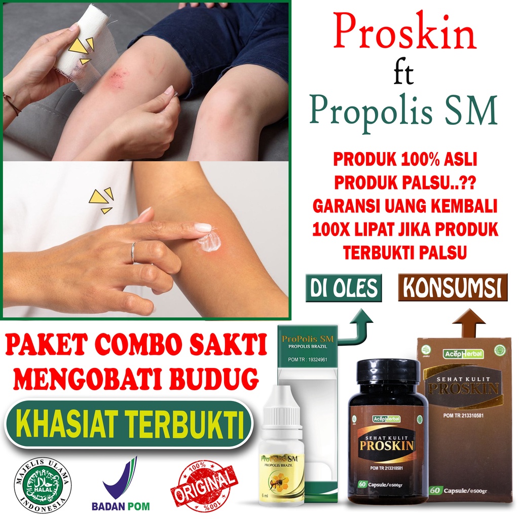 Obat Budug Bernanah Santri Buduk Di Kaki Penghilang Bekas Koreng Babak Gatal Kulit Biduran Kaligata Gatel Alergi Dingin Makanan Kapsul Herbal Menghilangkan Bentol Anak dan Dewasa PROSKIN Ekstrak Binahong Propolis SM BPOM Tanpa Efek Samping NO Salep Cina