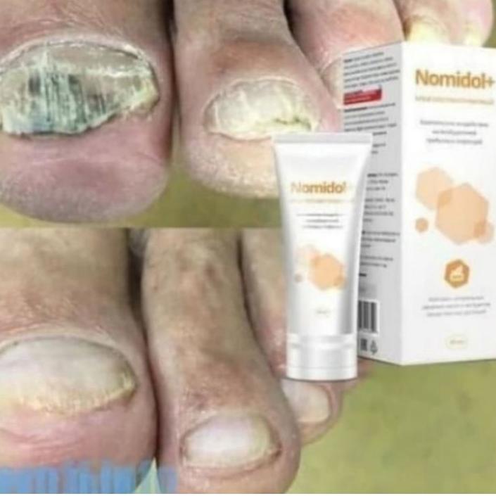 ▼ Nomidol cream jamur kuku kualitas istimewah nomidol asli original ➥