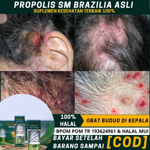 Obat Kepala Budug, Borok Kepala, Obat Borok, Koreng Di Kepala Anak Dan Dewasa Dgn  Propolis SM Origi