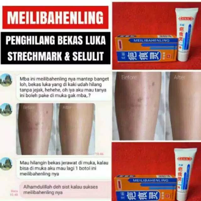 [BPOM] MEILIBAHENLING KRIM PENGHILANG BEKAS JERAWAT LUKA HITAM KORENG 40ML