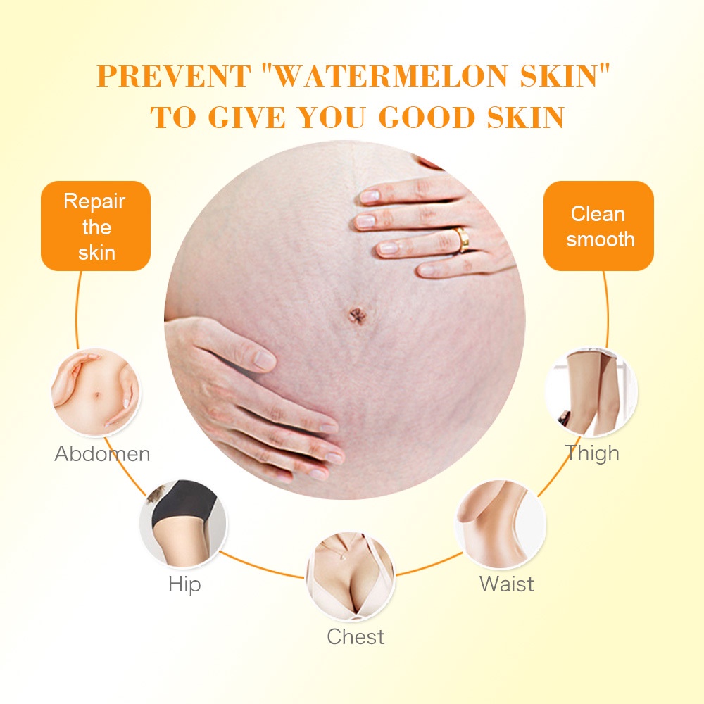 【O'RANNLE】 Stretch Mark Cream Mama's Choice Bisa dipakai ibu hamil   Menghilangkan stretch mark Memudarkan stretch mark Lotion tubuh stretch mark Krim perbaikan pasca persalinan Garis kegemukan Garis pertumbuhan