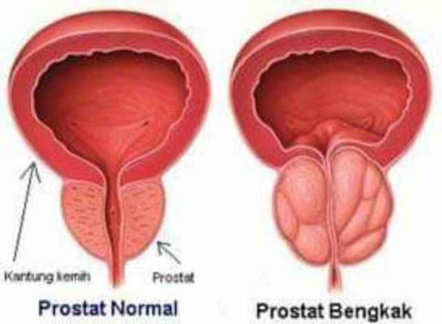 prostatitis poros