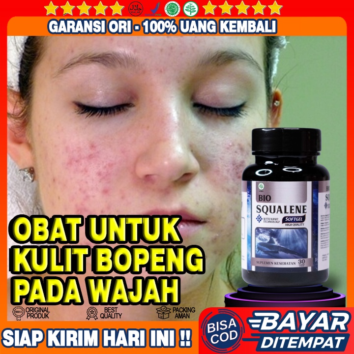 Obat Alami Bopeng Pada Wajah - Obat Bopeng Menahun - Obat Bopeng Jerawat - Obat Bopeng Bekas Jerawat