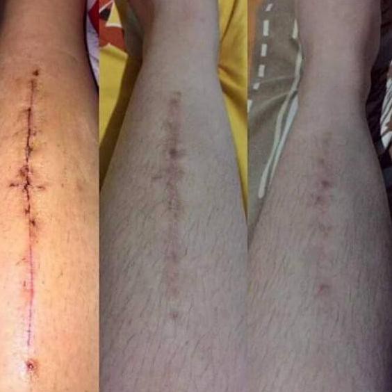 PENGHILANG BEKAS LUKA BIO HERBAL MEILBAHENLING ORIGINAL BPOM CREAM LUKA PERAWATAN TUBUH